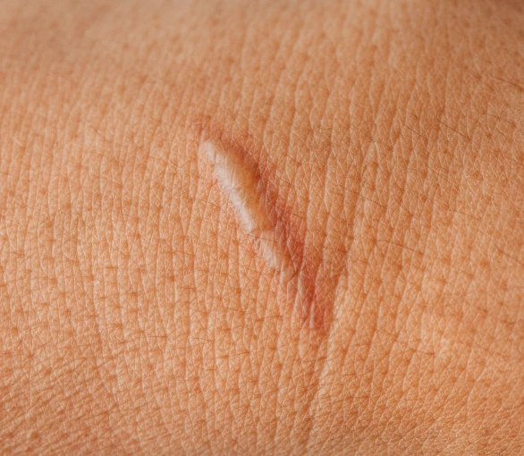 Close-up of a healed linear scar on skin, slightly raised and lighter than the surrounding tone