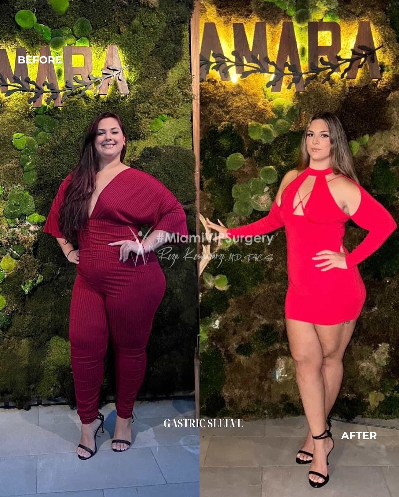 Before and after gastric sleeve surgery: a woman in a burgundy outfit, then slimmer in a red dress at the same venue