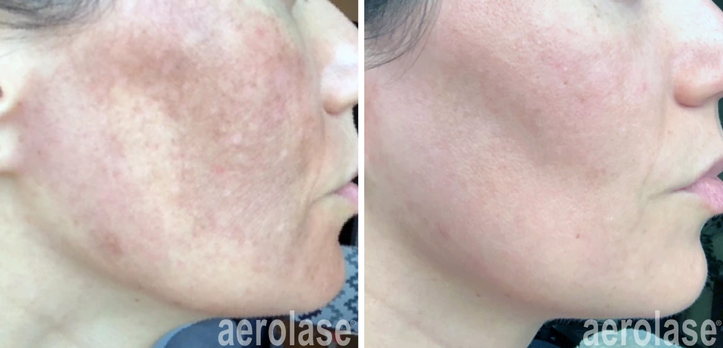 Before and after laser treatment: side view of a cheek with patchy brown pigmentation, then a lighter, more uniform complexion