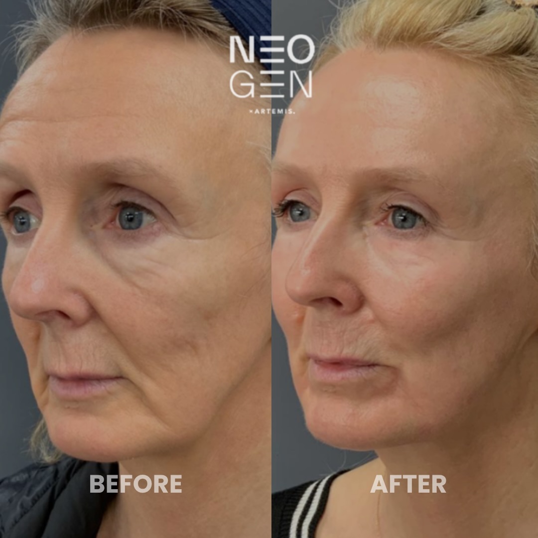 Older woman's face in three-quarter view before and after NeoGen plasma resurfacing, with smoother cheek and eye lines