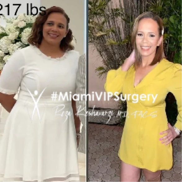 Gastric sleeve before and after of a woman in a white dress, then slimmer in a yellow dress