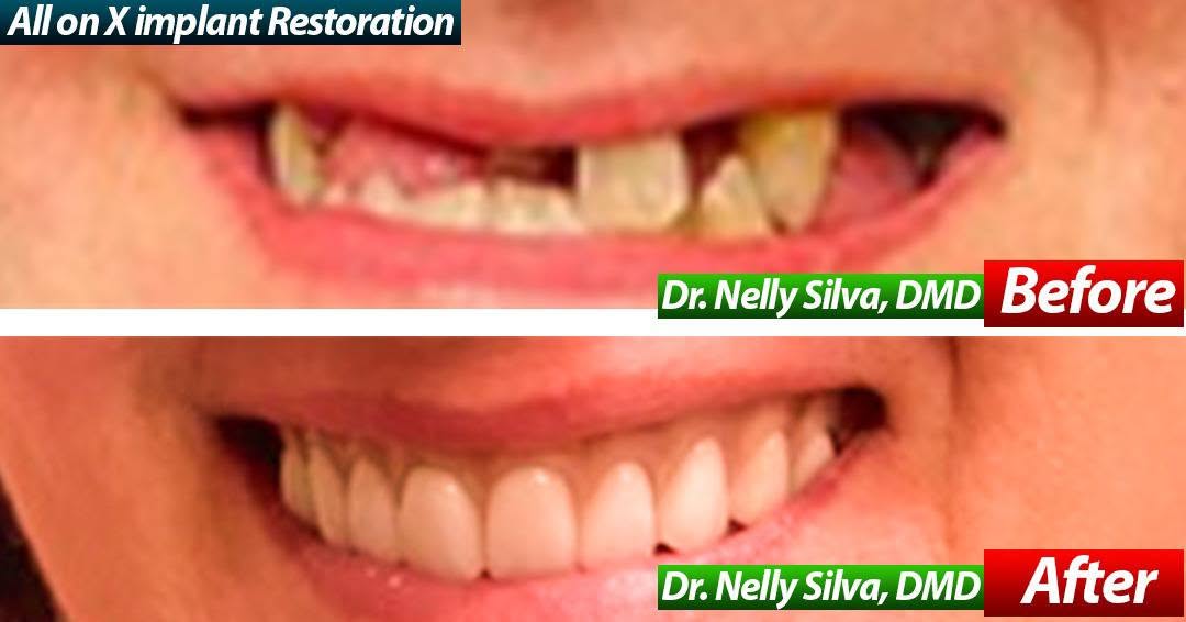 Before and after of an All-on-X full-arch dental implant restoration, missing and broken upper teeth replaced with a fixed arch
