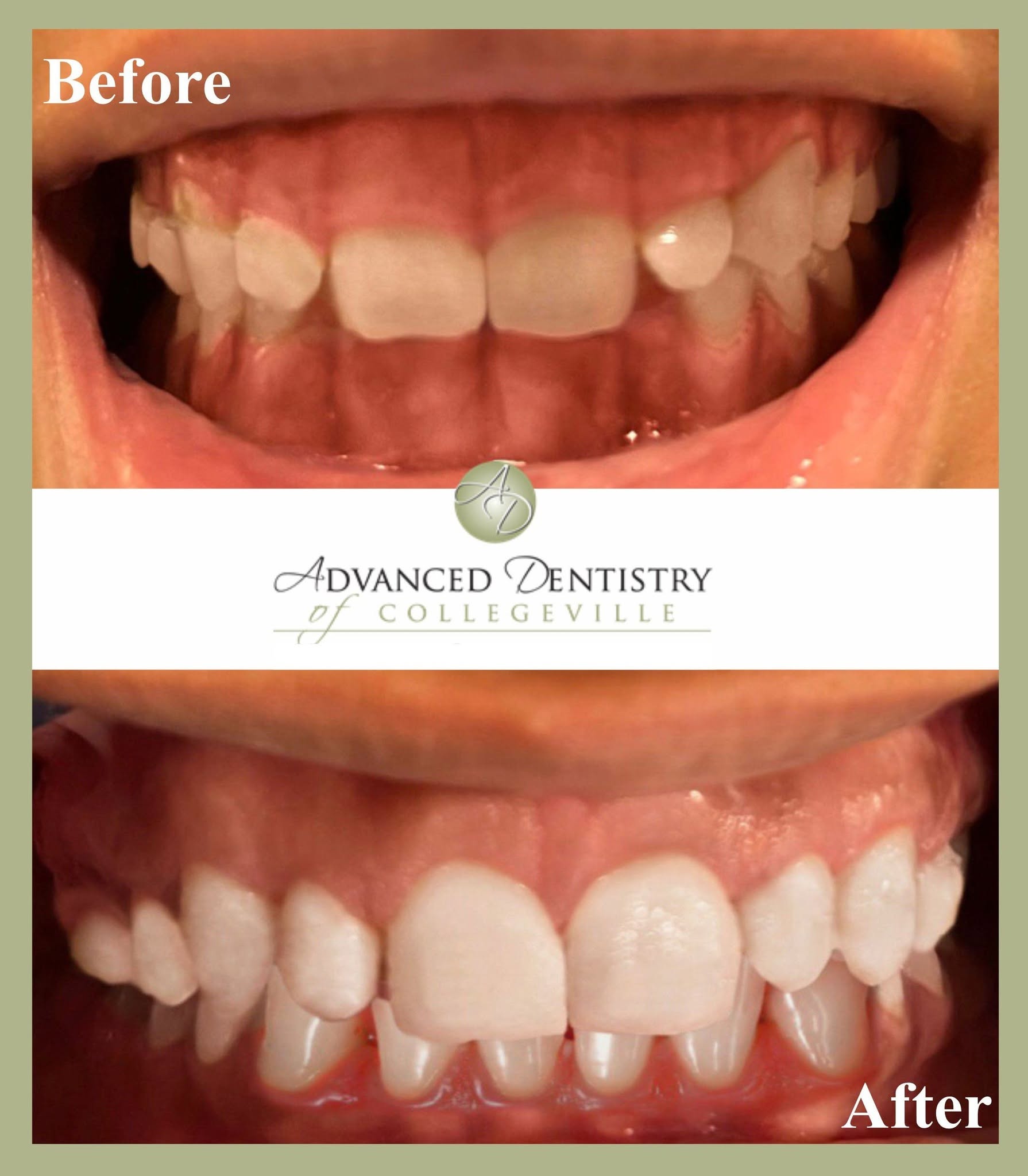 Before and after of uneven, narrow front teeth rebuilt to a fuller, even shape