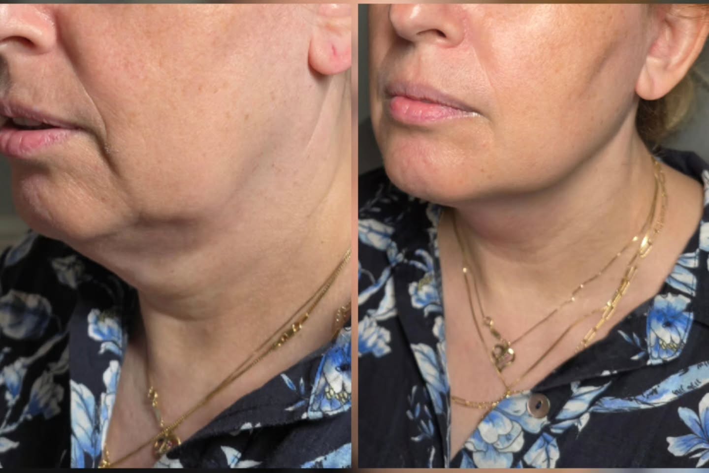Before and after a non-surgical necklift: a woman's neck and jawline, with looser skin under the chin before and a firmer jawline after one session