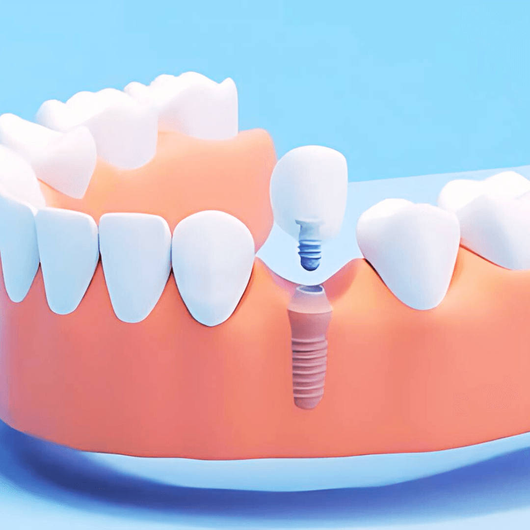 Illustration of a dental implant post and crown replacing one missing tooth between natural teeth