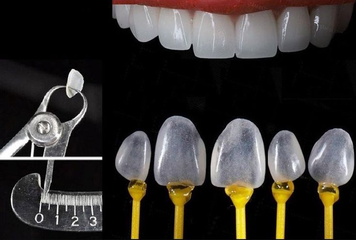 Collage showing feldspathic porcelain veneers, including a finished smile, individual veneer shells, and fitting tools used i