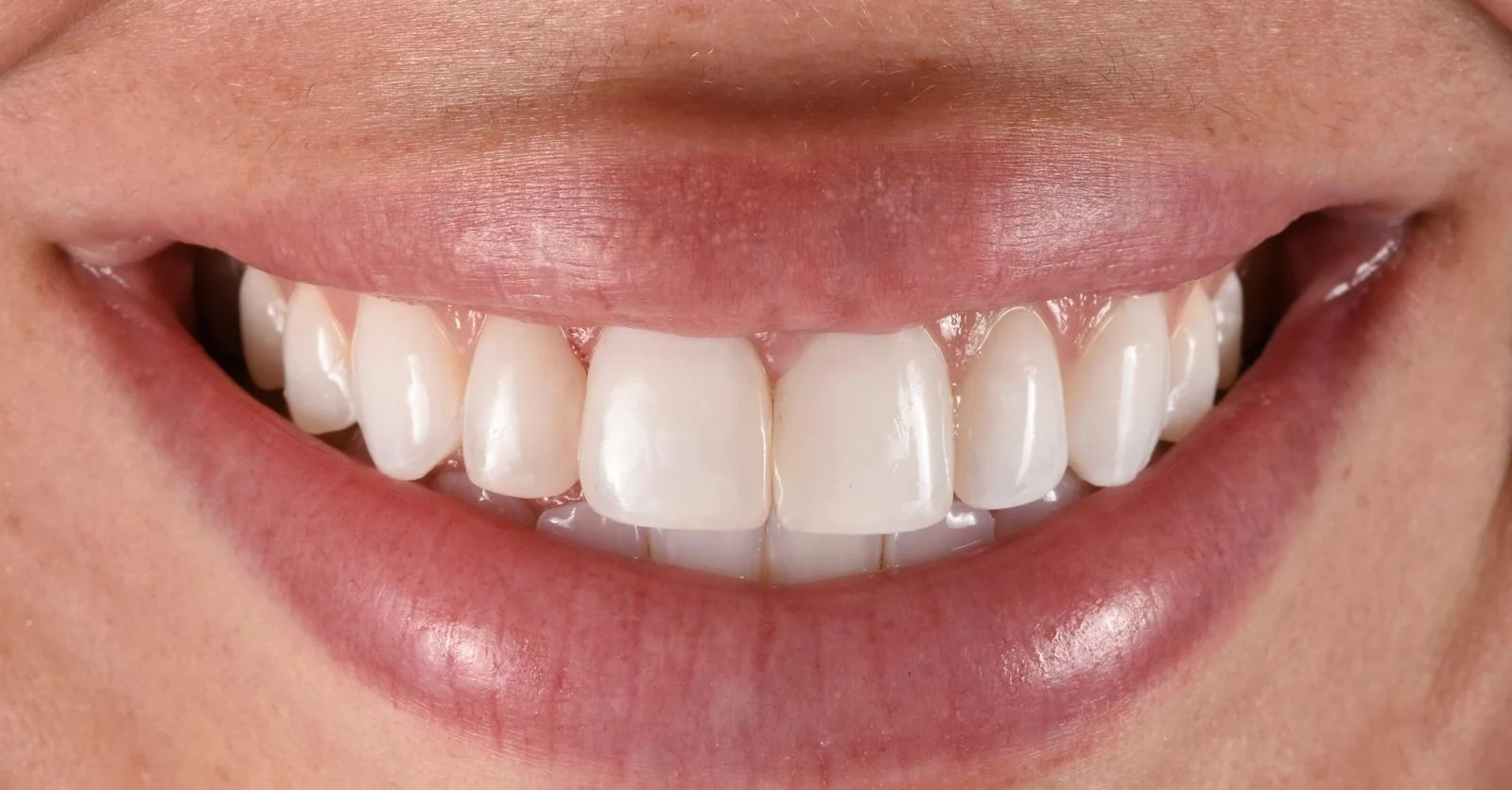 Extreme close-up of a person's smile showing bright, evenly shaped white teeth