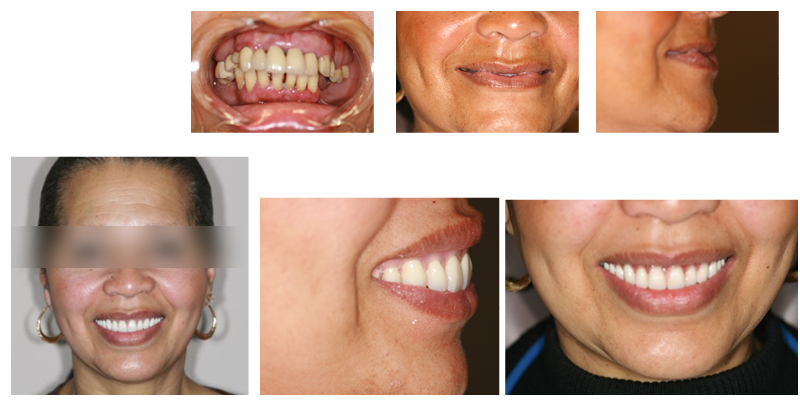 Before and after of a dental implant case, worn and missing teeth restored to a full, even smile
