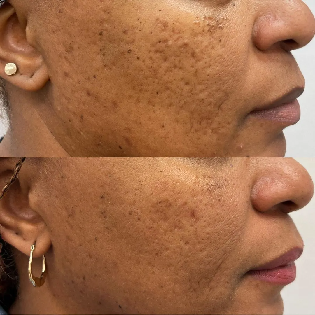 Cheek of a patient with a deep skin tone before treatment on top and after on the bottom, with smoother texture and fewer dark marks