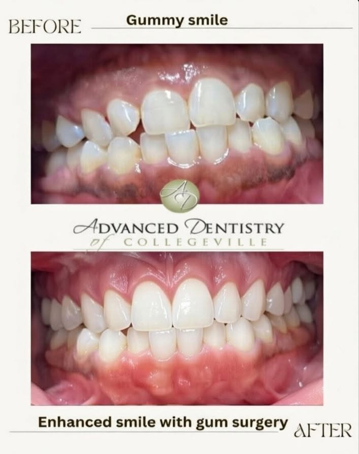 Before gummy smile correction: gum tissue covering much of the upper teeth