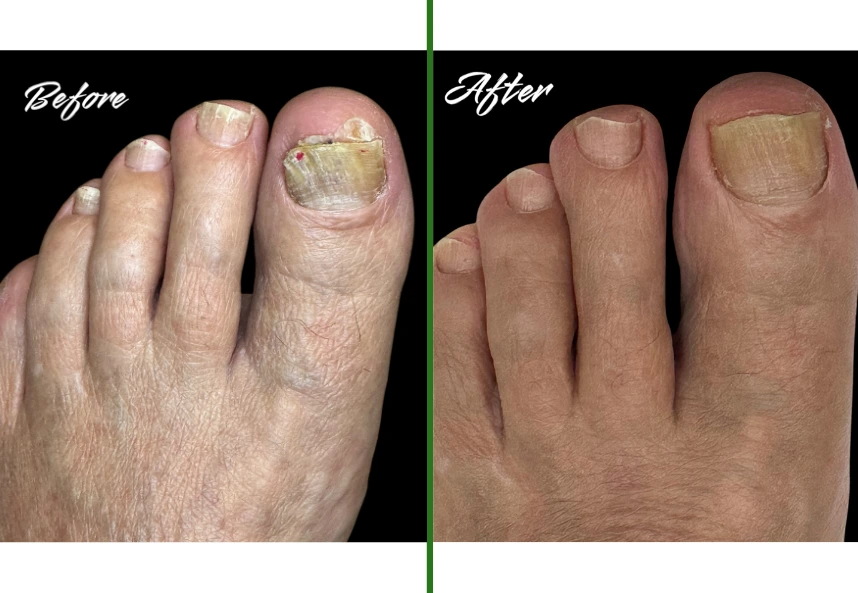 Before and after laser nail fungus treatment: a thick, yellowed big toenail on the left and clearer regrown nail on the right