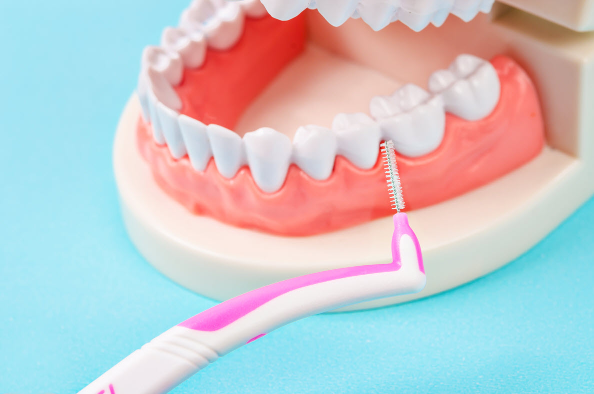 Interdental brush cleaning between the teeth on a dental model, the technique we teach patients with bleeding gums