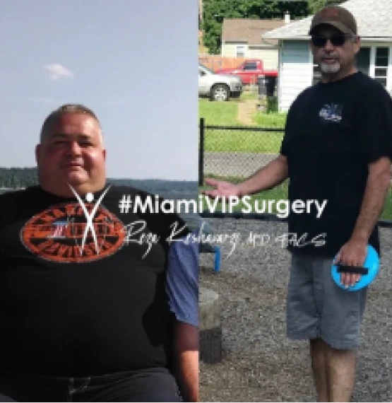 Before and after bariatric surgery: a man in a black t-shirt by the water, then much slimmer standing in a yard