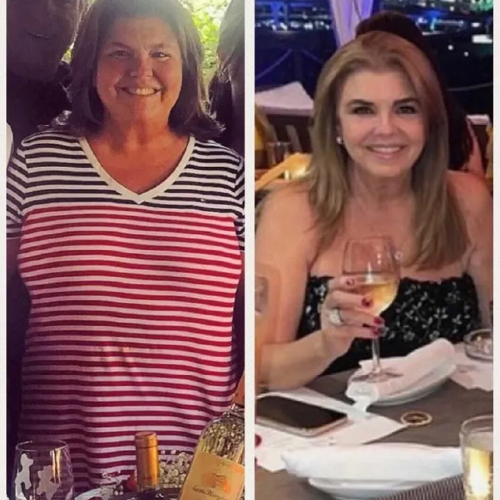 Before and after bariatric surgery: a woman in a striped top, then slimmer at a dinner table in a black top