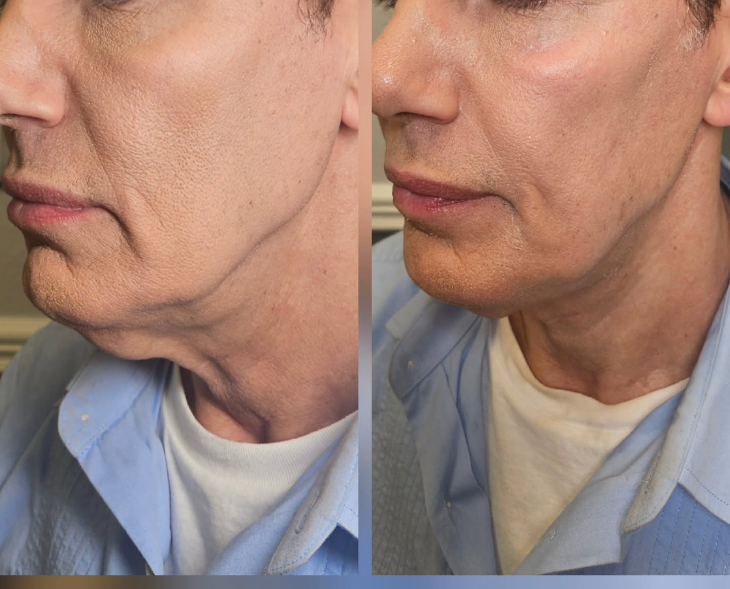Three-quarter view of a woman's jaw and neck before and 40 minutes after a non-surgical necklift, with less sagging under the jaw