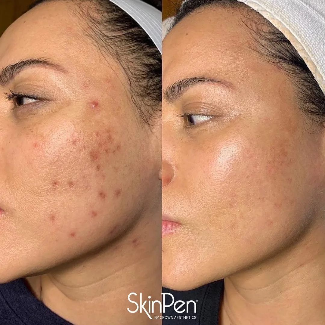 Before and after SkinPen microneedling on a woman's cheek showing fewer acne marks and smoother texture