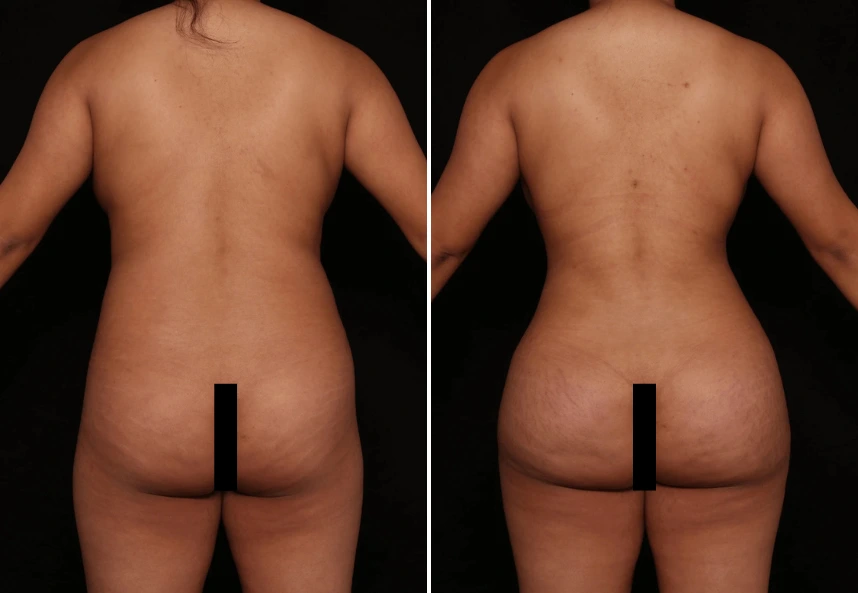 Before and after Vaser Lipo 360 and Brazilian Butt Lift