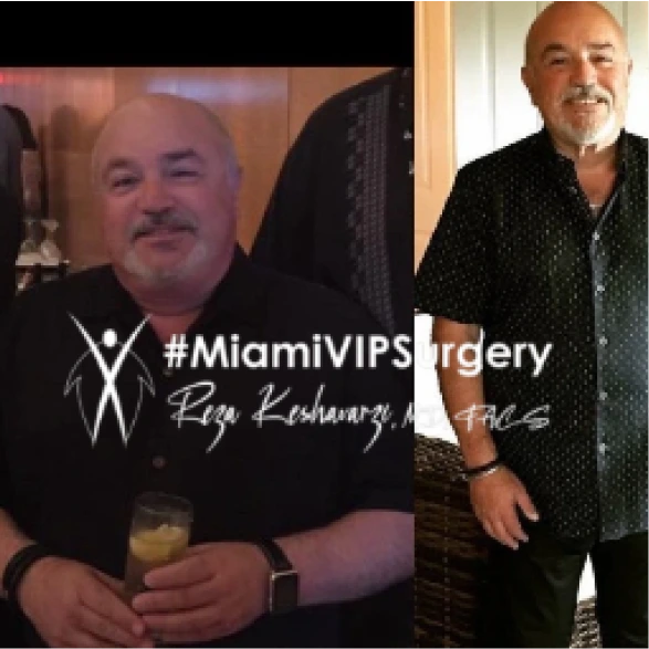 Gastric sleeve before and after of an older man in a dark shirt, then noticeably slimmer