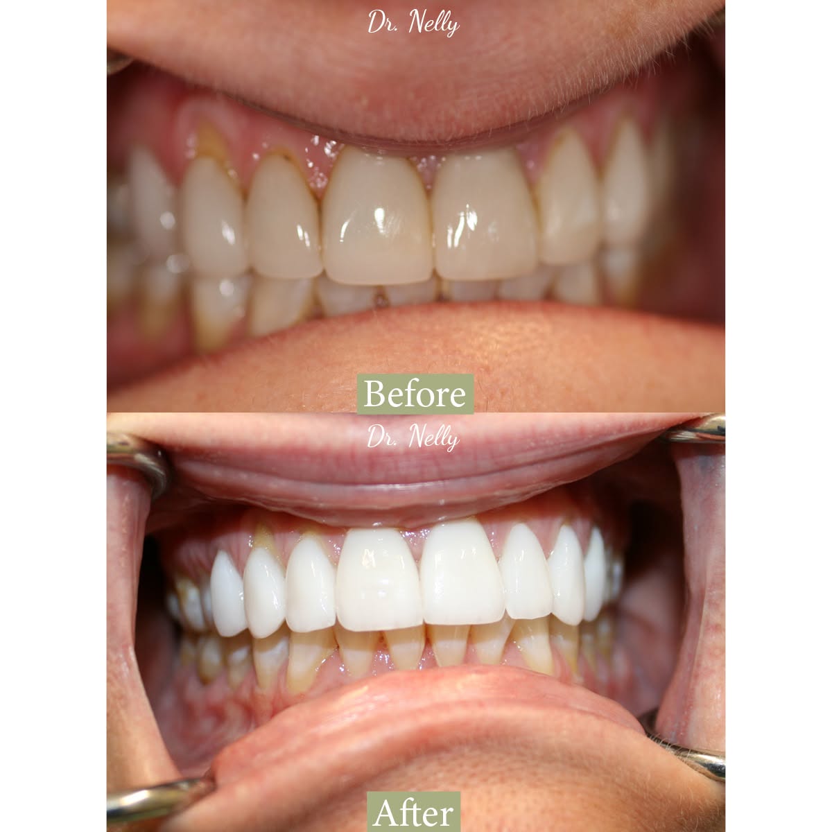 Before porcelain veneers: uneven shade and shape