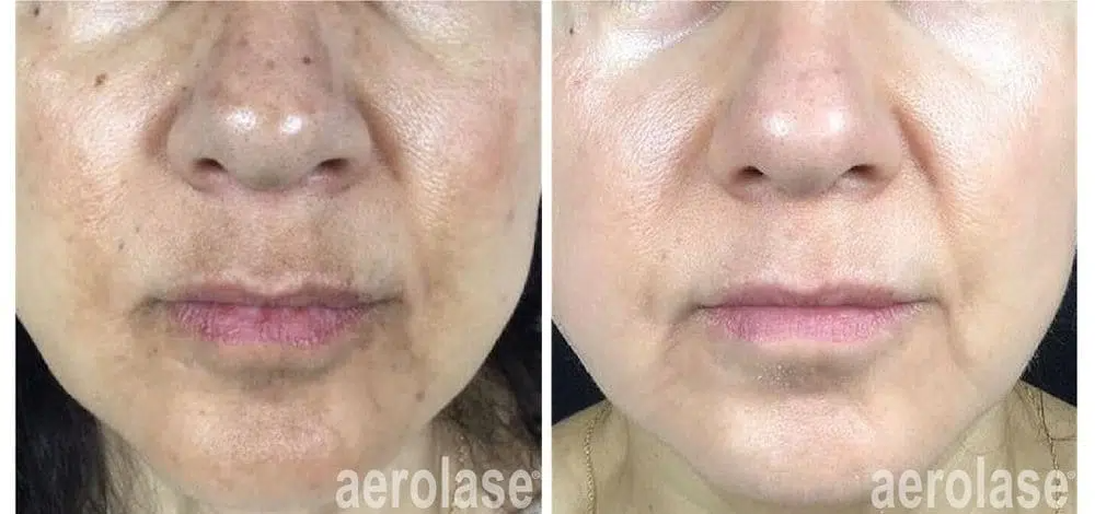 Lower face before and after Aerolase laser treatment, with softer lines around the mouth and more even tone