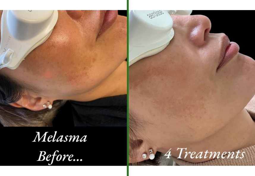 Before and after side view of melasma on a woman's cheek and jaw, lighter after four Aerolase laser treatments