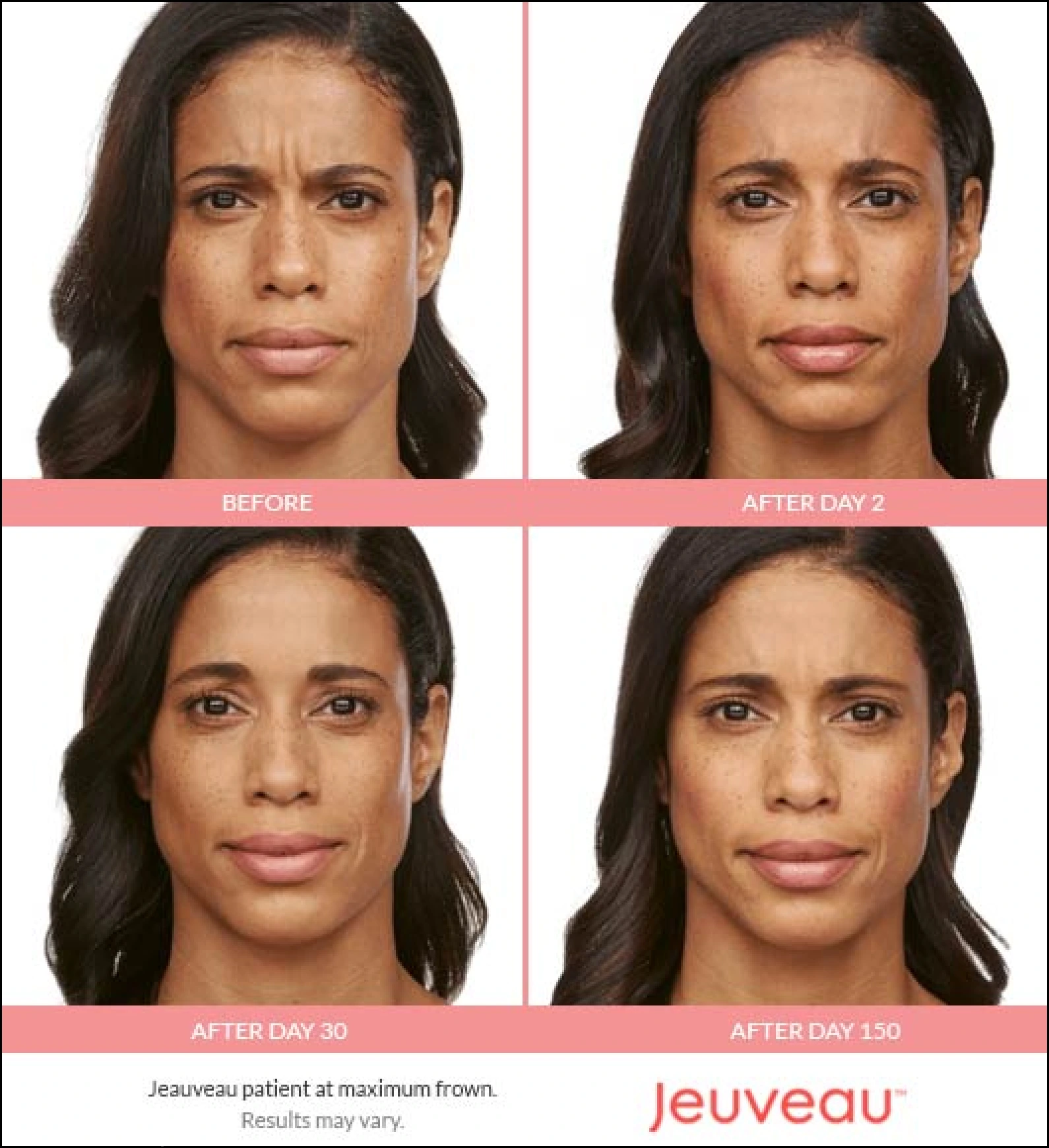 Woman at maximum frown before Jeuveau and at day 2, 30 and 150 after, showing reduced frown lines