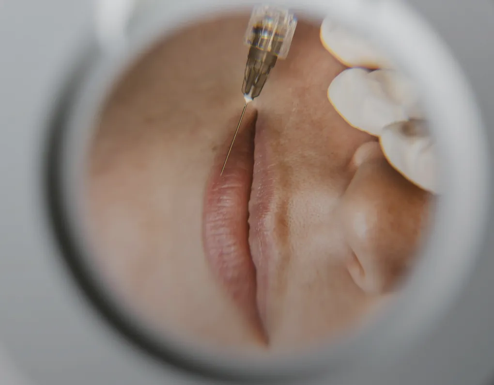 A lip filler injection seen through a hand mirror