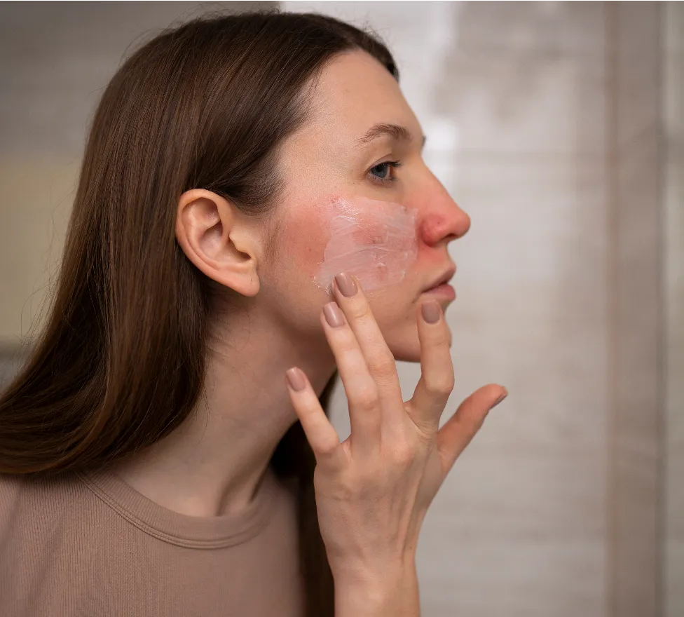 Woman touching her cheek where rosacea redness shows