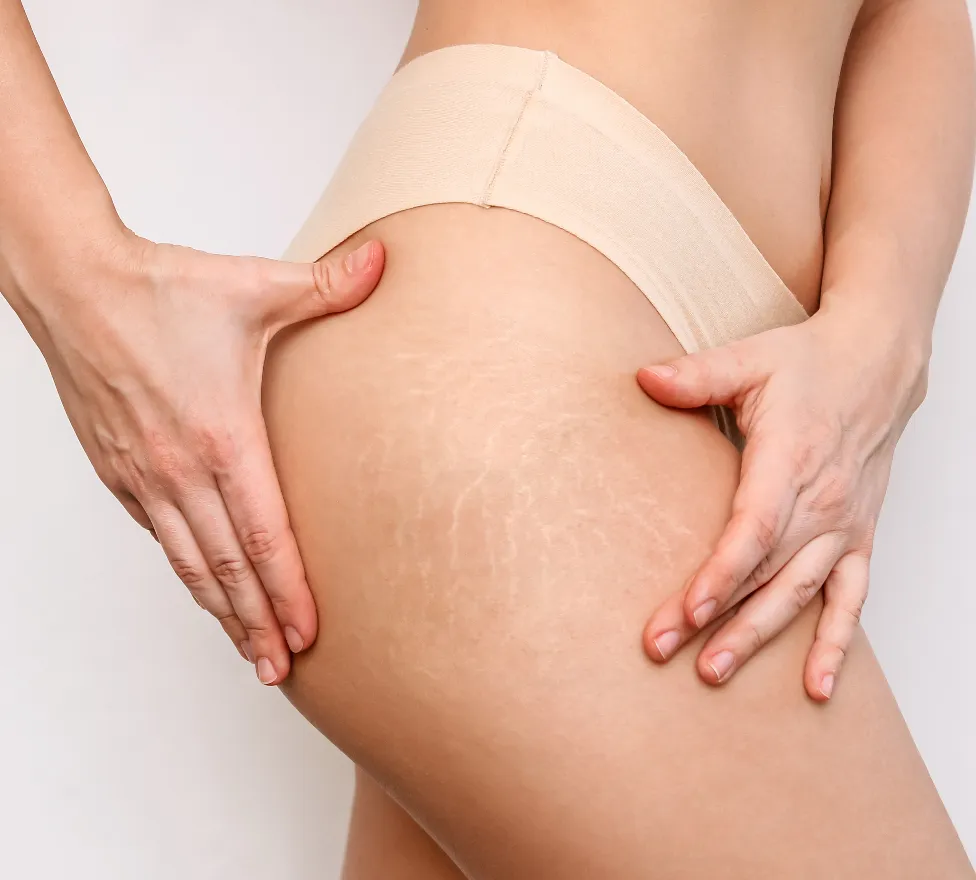 Woman holding her thigh to show stretch marks