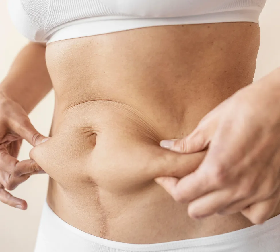 Woman pinching soft fat around her stomach