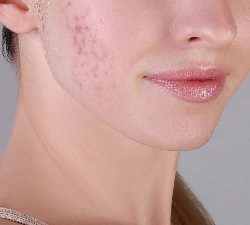 Close-up of a cheek with active acne