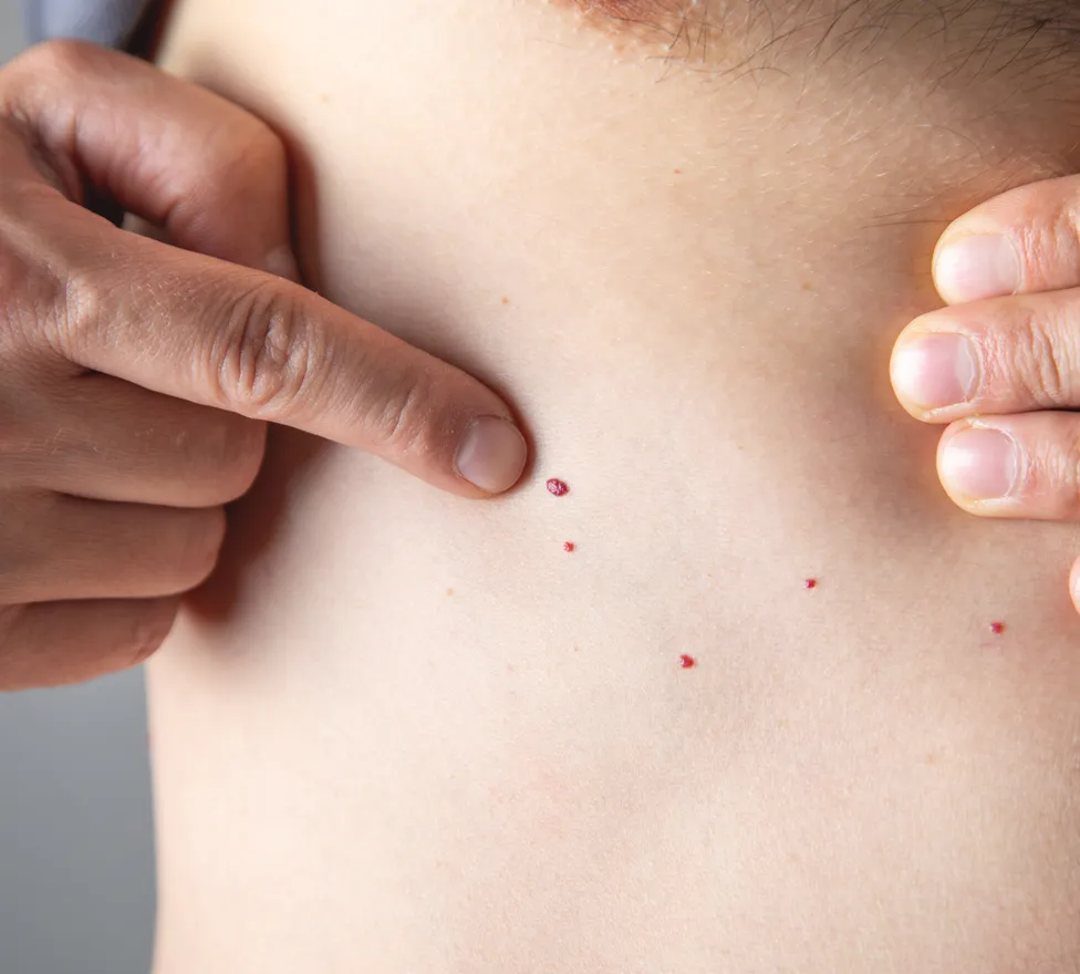 Finger pointing to small red cherry angiomas on the skin