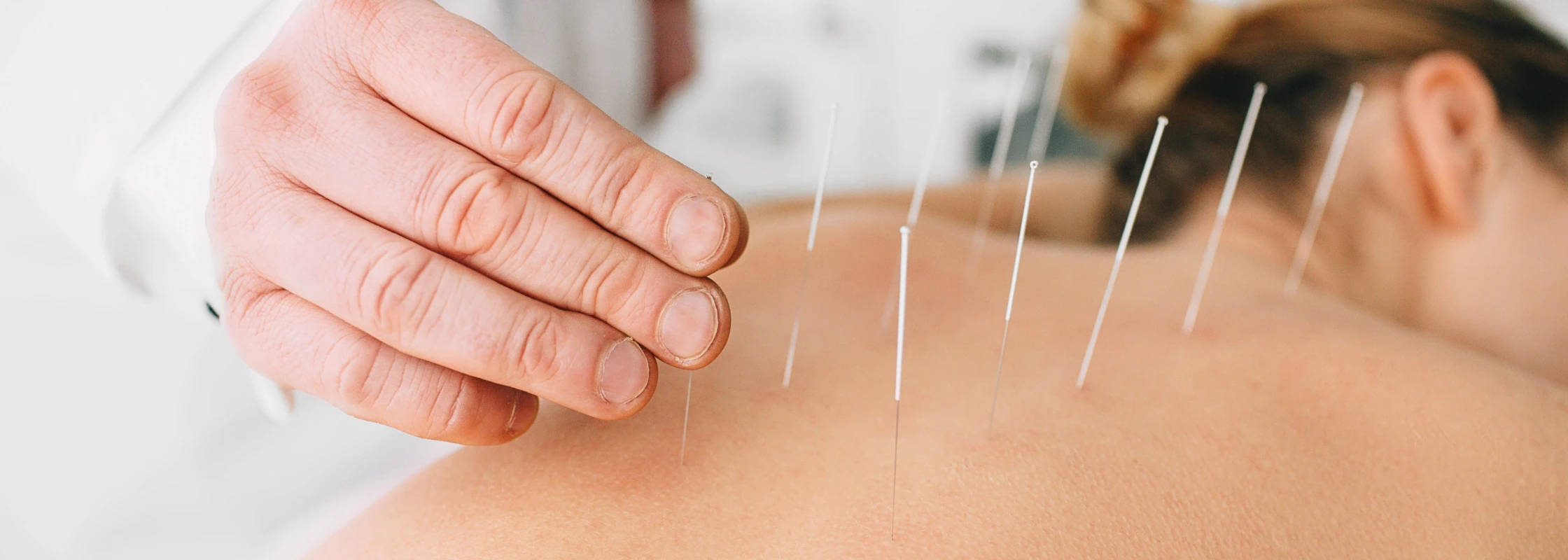 Could Acupuncture Work for You? Banner