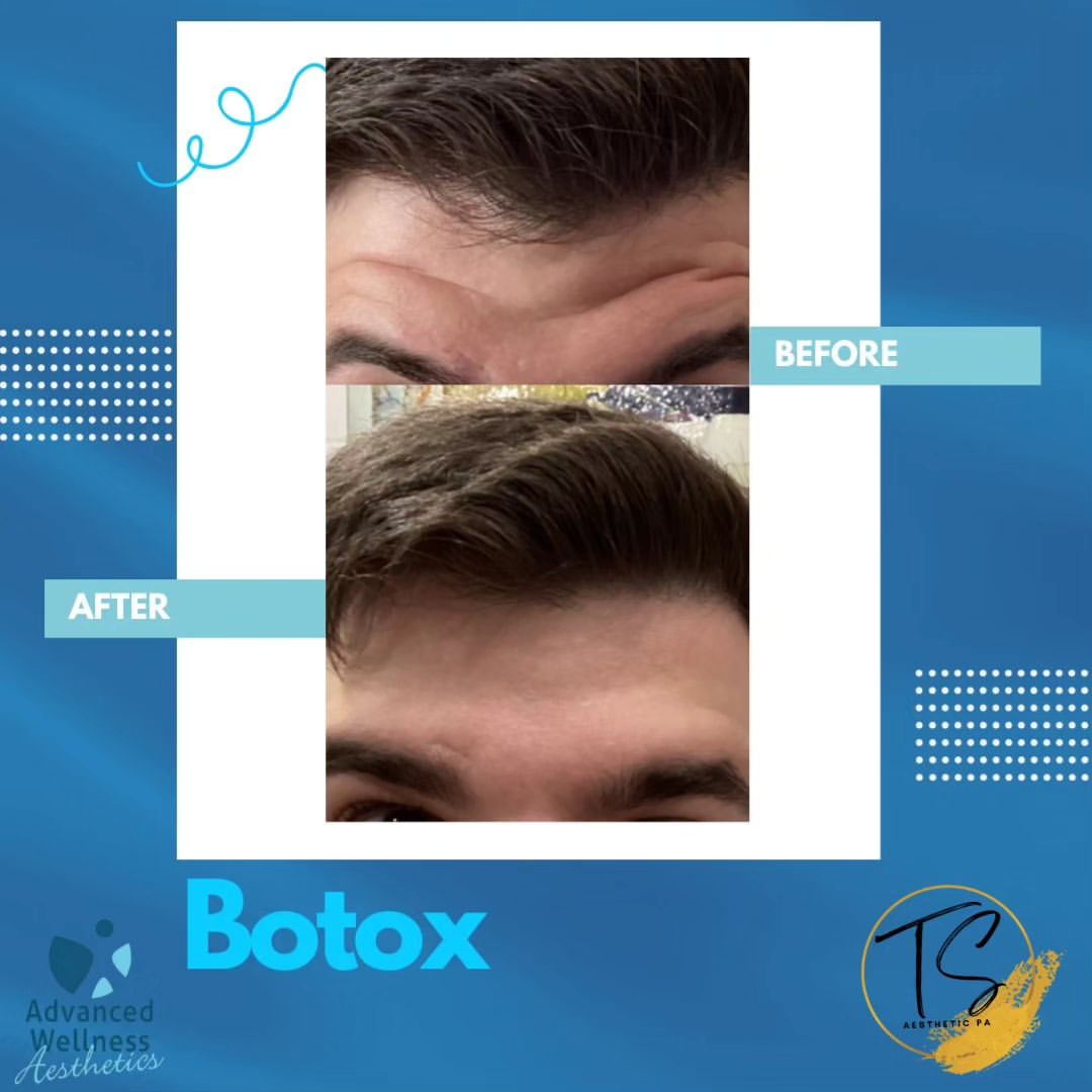 Botox