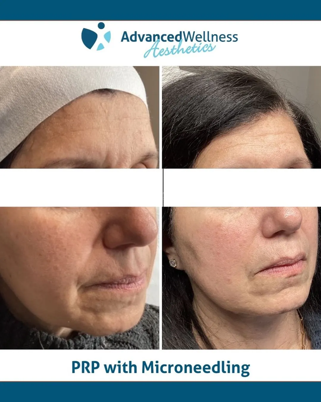 Platelet Rich Plasma (PRP) with microneedling 1.2