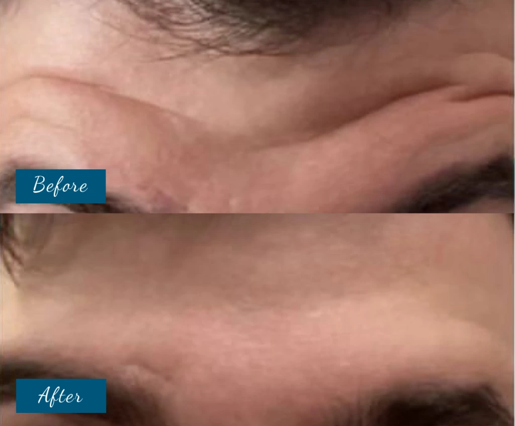 Botox Before & After