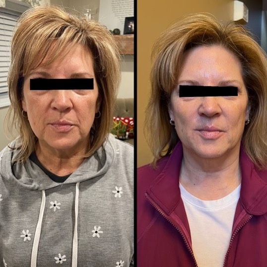 Micro-needling and cheek filler