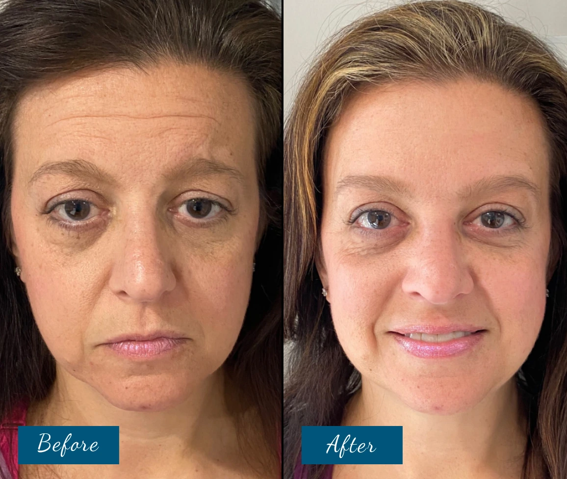 Botox Before & After Banner