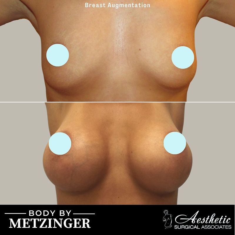 Breast_Augmentationbreast_augmentation_case8