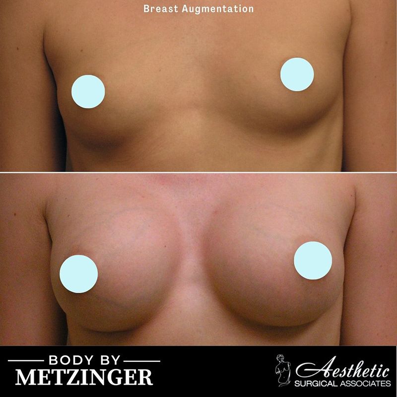 breast_augmentation_case10