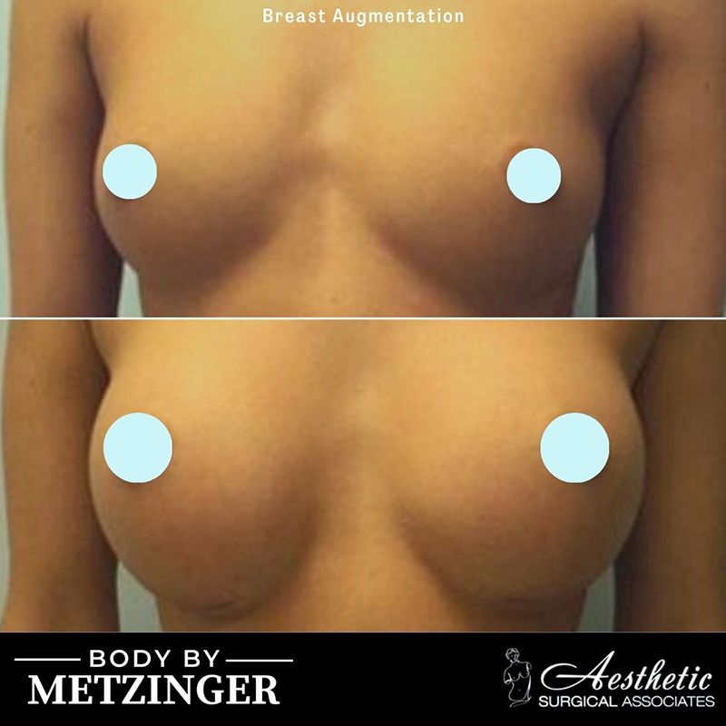 breast_augmentation_case23
