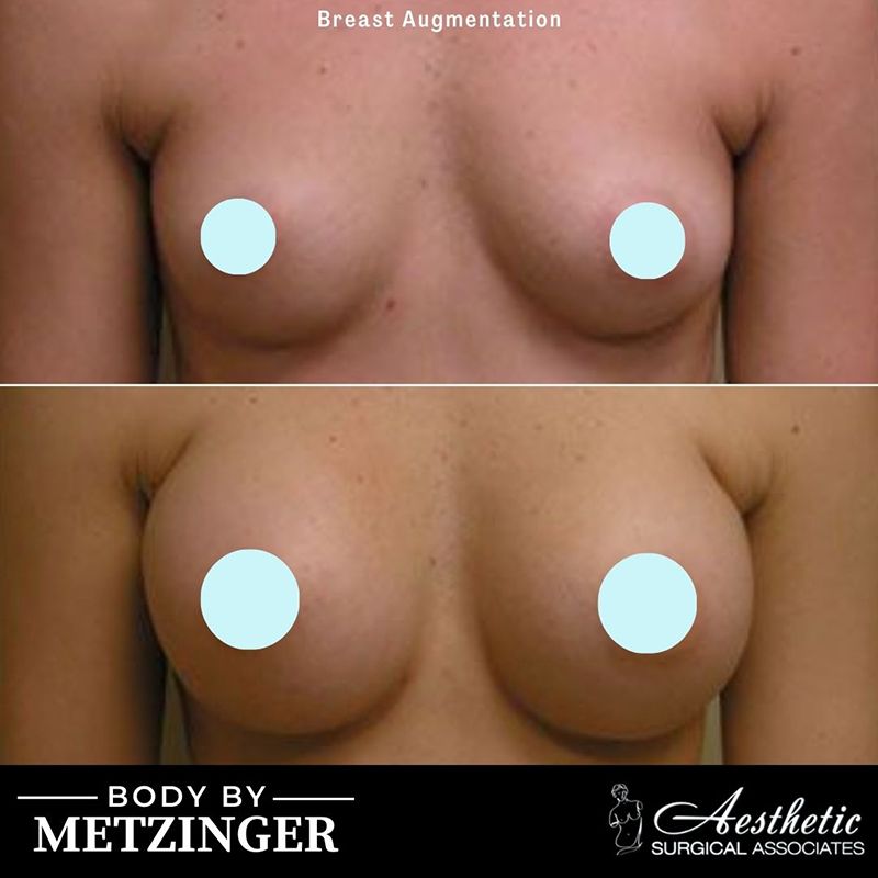 breast_augmentation_case24