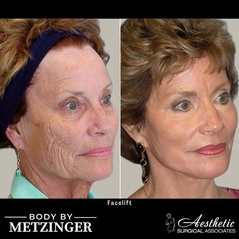 Before and After Gallery: Facelift banner