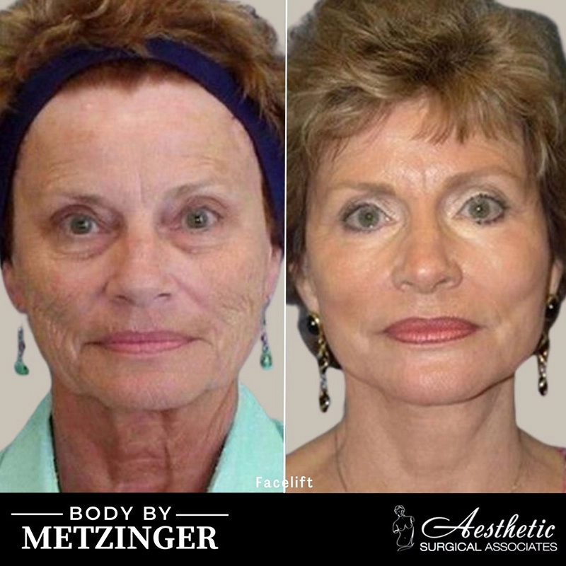 Before and After Gallery: Facelift banner