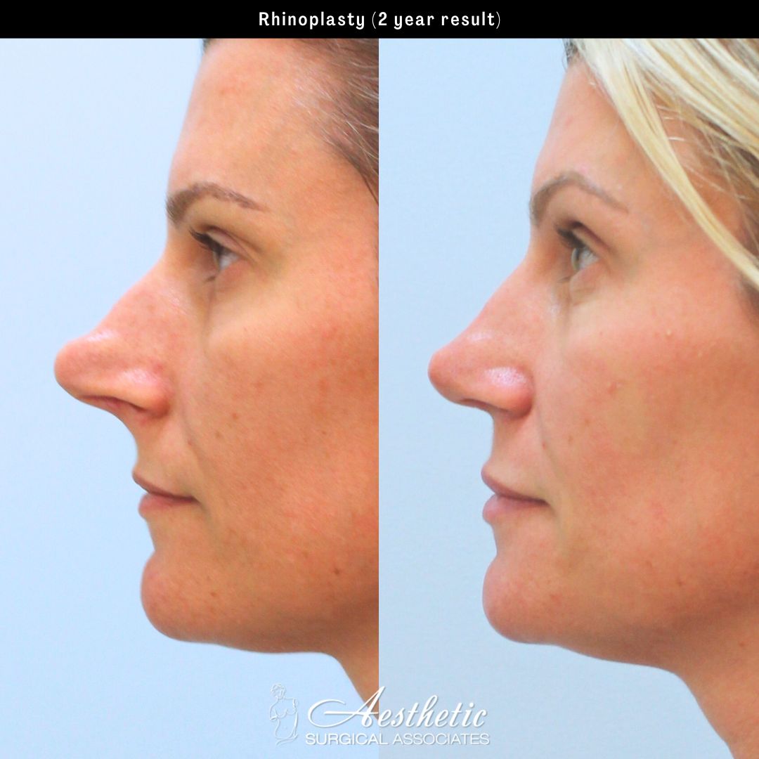 Before and After Gallery: Facelift banner