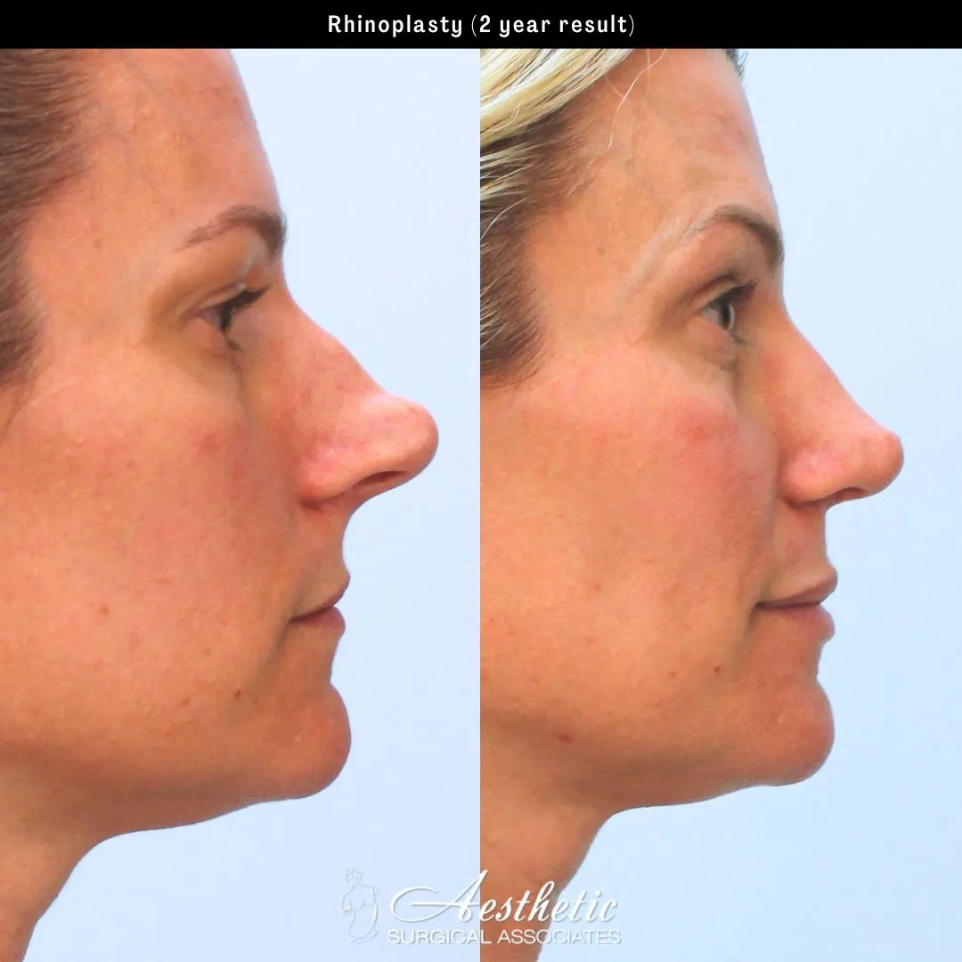 Before and After Gallery: Facelift banner