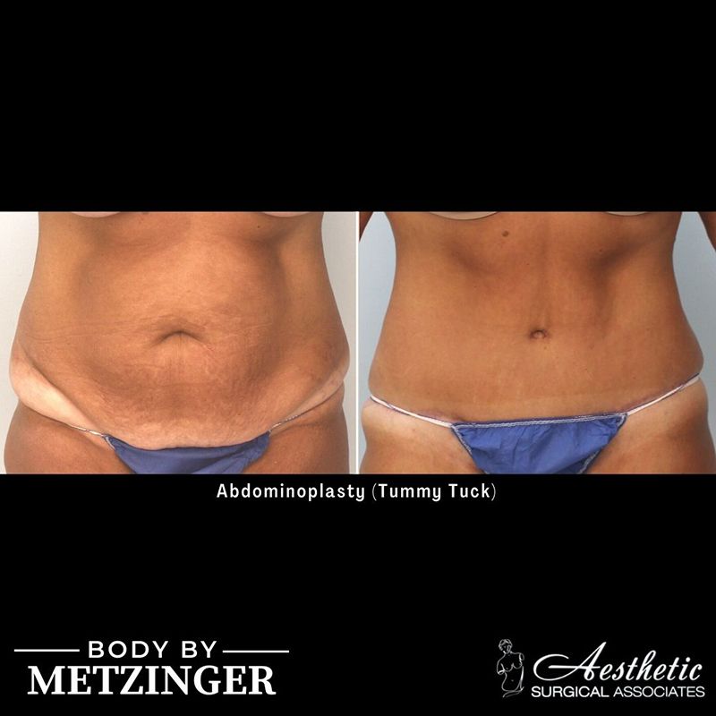Before and After Gallery: Tummy Tuck