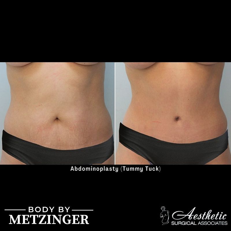 Before and After Gallery: Tummy Tuck