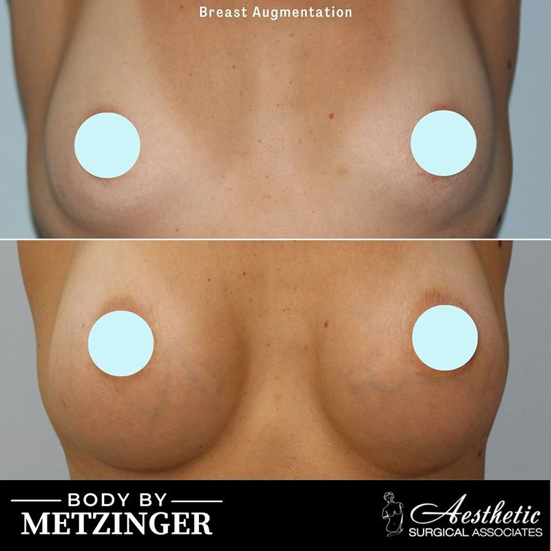 breast_augmentation_case11