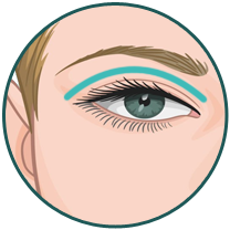 Upper Eyelid Banner